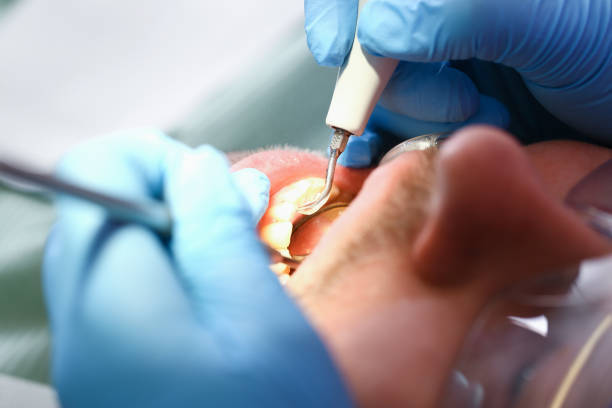 Best Emergency Dental Care for Broken or Chipped Teeth in Akron, OH